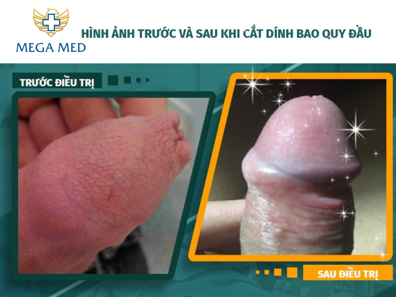 Hình ảnh trước và sau khi điều trị cắt dính bao quy đầu